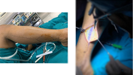 Jaw Bone Cancer Treatment